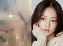 Bạn trai hé lộ vết thương trên mặt do 'Búp bê xứ Hàn' Goo Hara gây ra