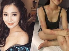 Hương Tràm bị dị ứng cấp tính, nổi từng mảng khắp người