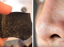 6 điều nên biết trước khi lột mụn đầu đen